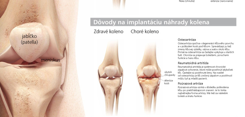 Plakát koleno